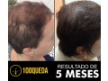 trinoxidil-americano-o-unico-tratamento-do-mundo-capaz-de-restaurar-ate-2000-fios-de-cabelo-por-semana-small-2